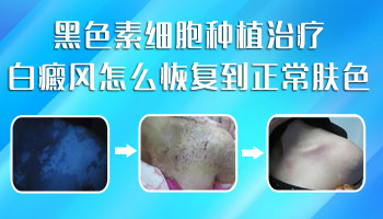 孩子身上有大面积白斑什么情况 如何治疗