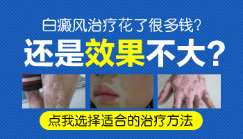小孩身上长小白块抹他克莫司多久能好