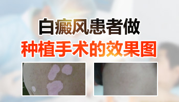 小孩身上有一片白怎么回事