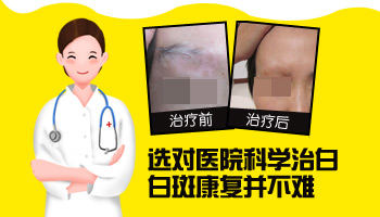 男孩脸上有大面积白斑抹药膏效果怎么样